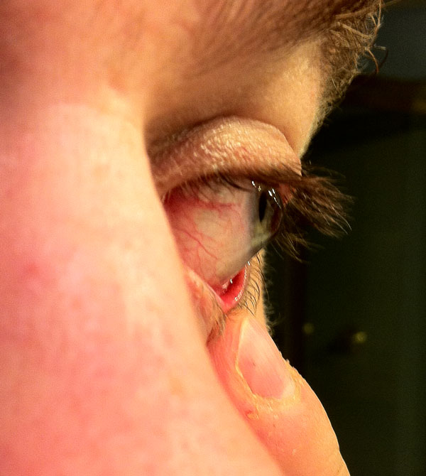 Keratoconus - Cone visible from side