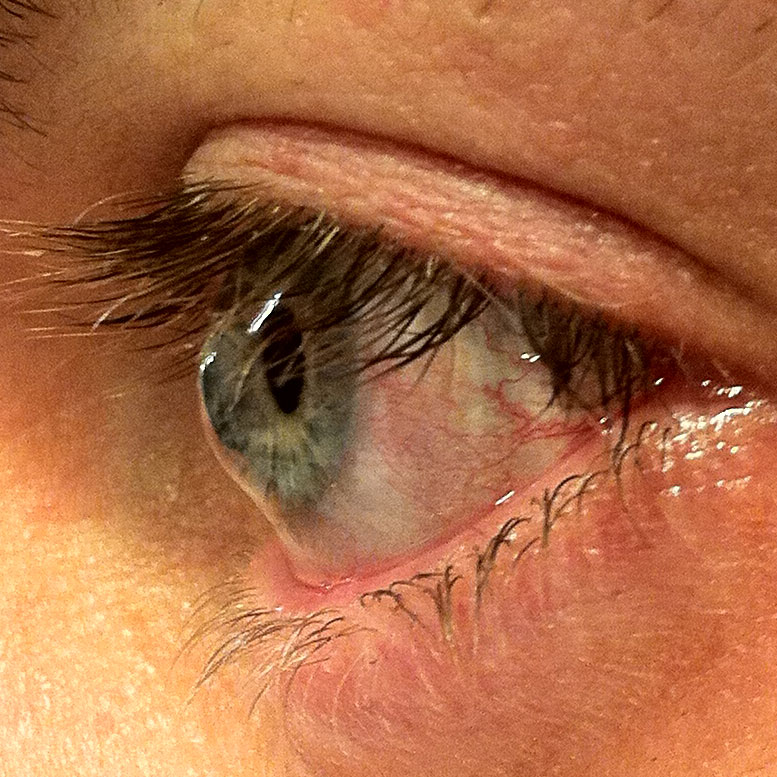 Keratoconus - Cone visible from side