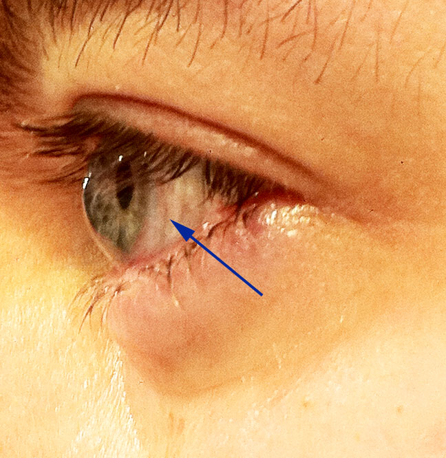 Keratoconus - Cornea Covered by Semi Scleral Lens
