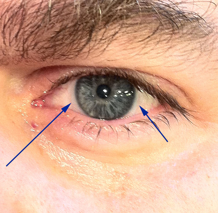 Keratoconus - Cornea Covered by Semi Scleral Lens