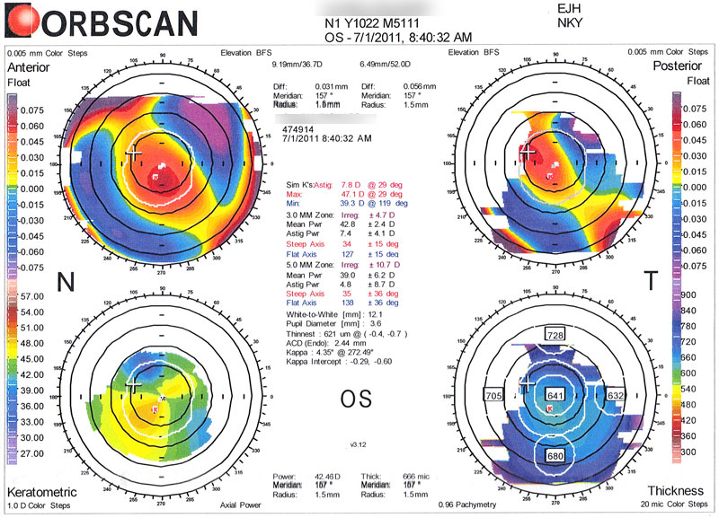 Corneal Topography - Graft