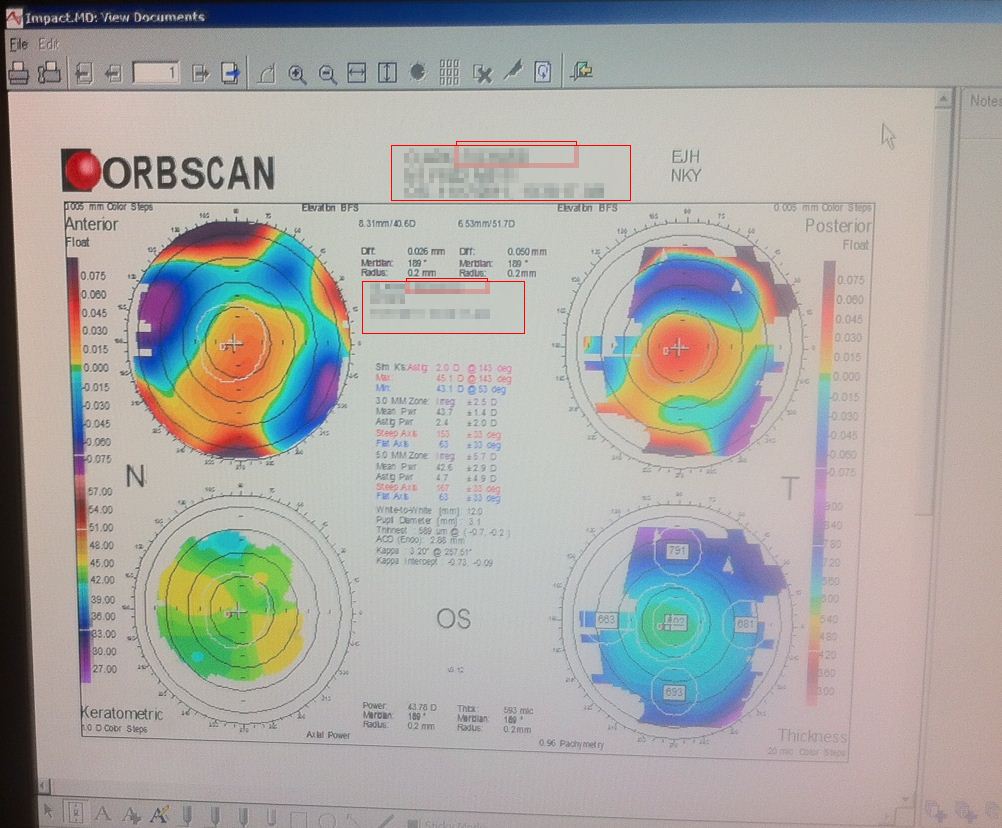 Post Corneal Transplant Topography 8 months