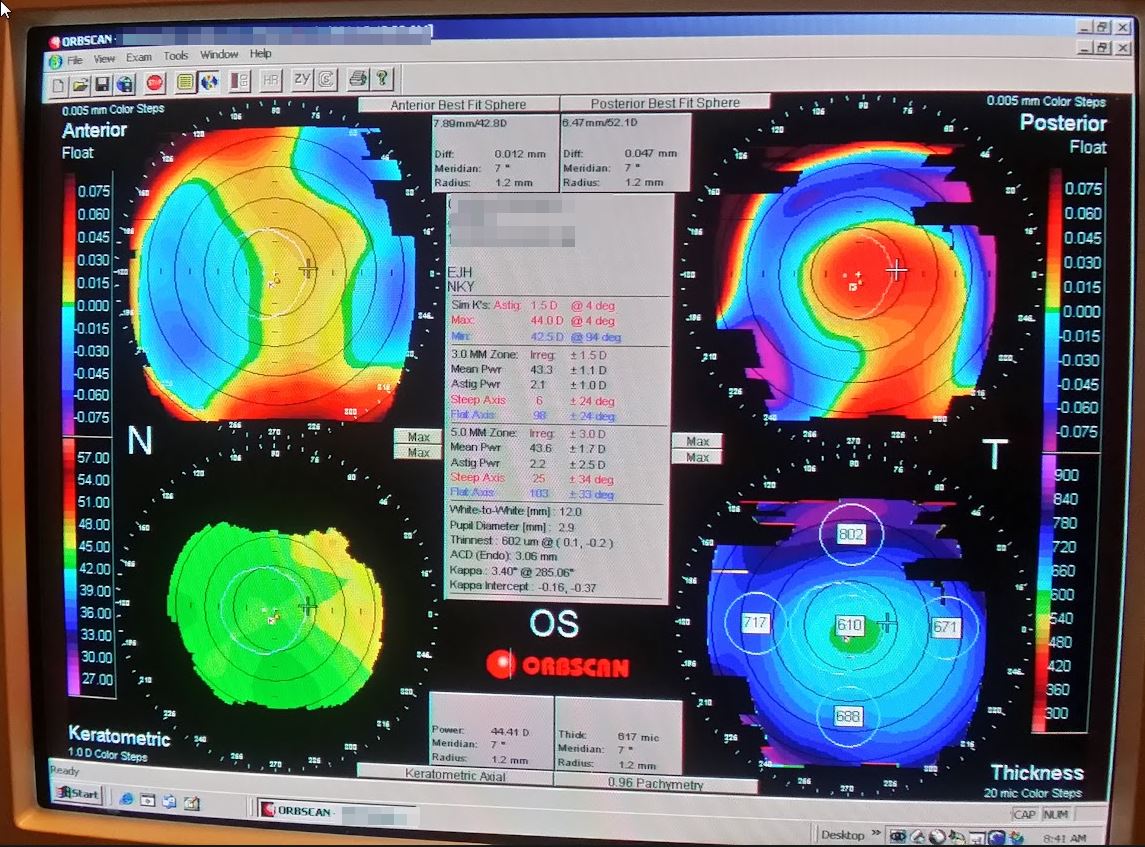 orbscan-1-4-13